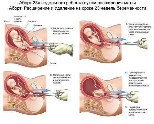Aborcja 7