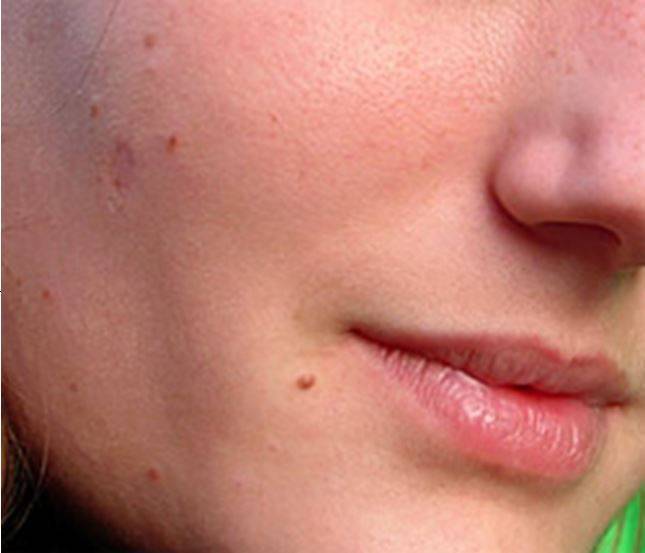 skin tag on face