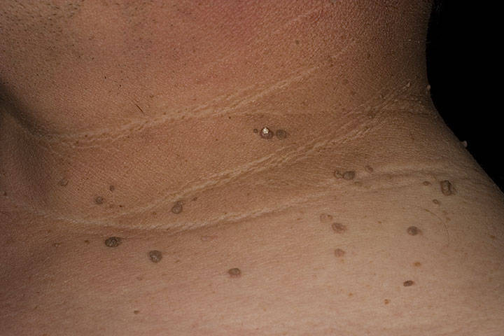skin tags or fibroepithelial polyps