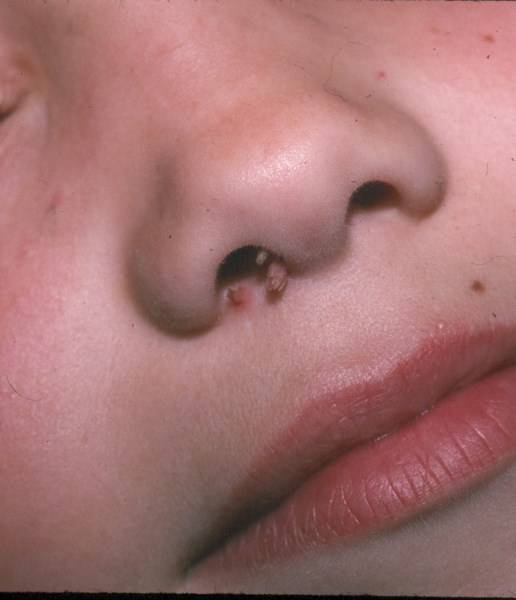 skin tag in nose