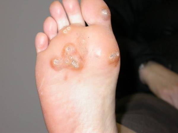 Warts